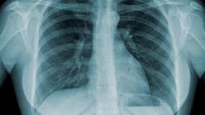 tuberculose 1